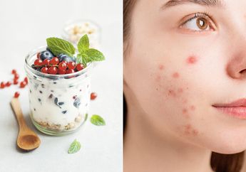 Makanan Penyebab Jerawat di Pipi, Ternyata Bukan Cuma Gorengan, Minuman Sehari-hari ini Juga Biang Keroknya