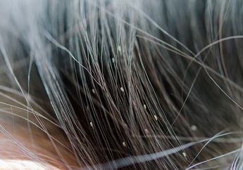 4 Cara Menghilangkan Kutu Rambut Secara Alami, Bisa Pakai Bawang Putih