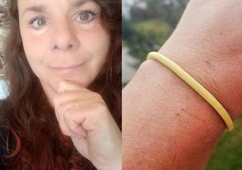 Mengerikan Banget! Wanita Ini 30 Tahun Tidak Pernah Melepas Karet Gelang di Tangannya, Kondisinya Berakhir Memprihatinkan