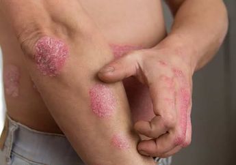 Tak Diobati, Waspada 7 Komplikasi Psoriasis Berikut yang Membahayakan