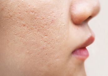 Cara Menghilangkan Bekas Jerawat dengan 4 Bahan Alami, Salah Satunya Bisa Pakai Madu