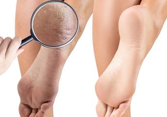 Kaki Bakal Mulus Lagi, Cara Mengatasi Tumit Pecah-pecah Modalnya Cuma Oleskan 1 Bahan di Dapur Ini, Sekali Coba Pasti Bikin Takjub
