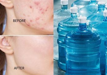 Nyesel Dari Dulu Beli Skincare Mahal, Padahal Jerawat Wanita ini Auto Hilang Cuma dengan Air Isi Ulang, Kok Bisa?