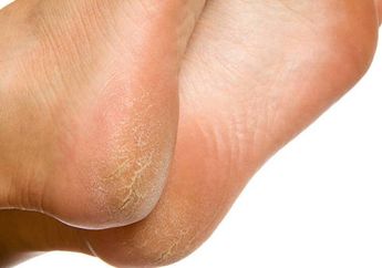 Cara Mengatasi Tumit Pecah-pecah dan Kasar Paling Ampuh, Cukup Gunakan 4 Bahan Alami Ini