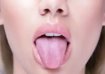 Awas Bingung! Ternyata Ini Perbedaan Kanker Lidah dan Kanker Mulut