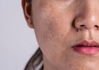 Cara Mengatasi Bintik Hitam yang Bikin Wajah Jadi Kusam, Cukup dengan 3 Bahan Ini Bikin Muka Jadi Mulus Lagi