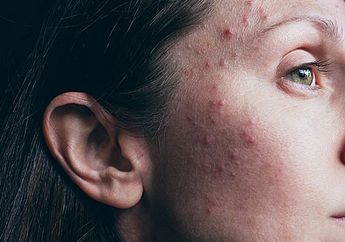 Udah Gede Masih Jerawatan? Ternyata Ini 11 Penyebab Adult Acne!