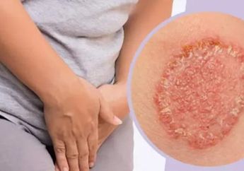 Cara Mencegah Kurap Muncul di Selangkangan Dengan Bahan Alami
