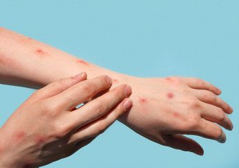 Dijamin Ampuh! Ini Cara Menghilangkan Bisul dengan Bawang Putih