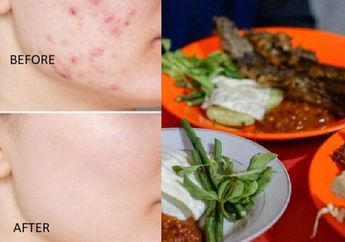 Ternyata Ada Cara Ampuh Mengatasi Jerawat Tanpa Perawatan, Cuma Perlu Diusap Pakai Lauk Pecel Lele ini