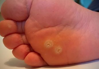 5 Cara Menghilangkan Mata Ikan di Telapak Kaki, Pakai Bahan Alami!