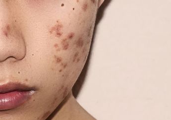 Pakai Skincare Tidak Mempan, Bekas Jerawat Baru Mau Lenyap dengan Tanaman dari Kebun Tetangga ini, Ajaib!
