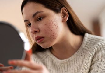 Beli Skincare Mahal-mahal, Ternyata Cukup Pakai Tanaman Ini Saja Sudah Bisa Menghilangkan Jerawat