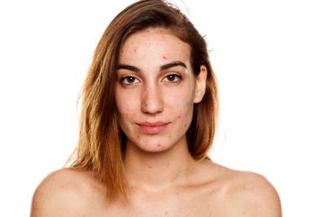Kenapa Muncul Jerawat Setelah Pakai Makeup? Ini Penyebabnya!