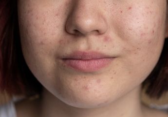 Menghilangkan Flek Hitam dengan Es Batu Apakah Bisa? Simak Ulasannya