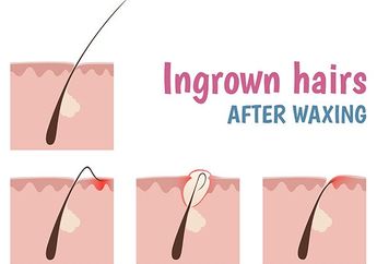 Kenali Penyebab Timbulnya Ingrown Hair, Alias Benjolan di Vagina