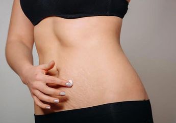8 Fakta Yang Perlu Kita Tahu Tentang Stretch Marks