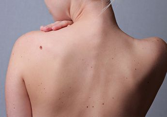 Wajib Tahu! Faktor Penyebab Meningkatnya Risiko Melanoma, Jenis Kanker Kulit Yang Patut Diwaspadai
