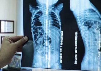Awalnya Susah Buang Air Kecil, Dokter Kaget di Tubuh Bayi Ini Ditemukan Belasan Jarum, Ternyata Ada yang Tega Lakukan Hal Ini