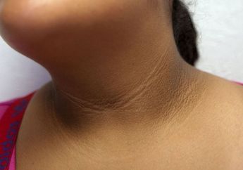 Lipatan Kulit Leher yang Gelap Adalah Gejala Awal Tanda Diabetes, Ini Gejala Lain yang Belum Kamu Tahu!