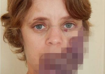 Wanita Ini Punya Tanda Lahir yang Membuatnya Kesulitan Makan dan Bicara