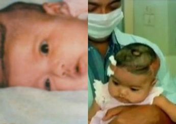 Dipisahkan 30 Tahun Lalu, Begini Kabar Bayi Kembar Siam Dempet Kepala yang Dulu Bikin Geger, Kondisinya Tak Disangka-sangka!