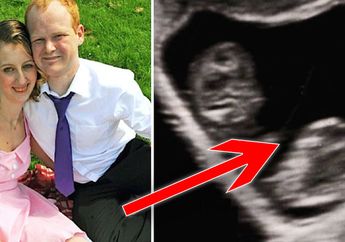 Awalnya Remaja 19 Tahun Ini Hamil Anak Kembar, Namun Hasil Pemeriksaan Ultrasound Ungkap Hal Tak Diduga di Balik Janinnya, Faktanya Bikin Tercengang!