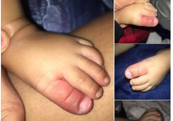 Kaki Bayi Ini Melepuh, Saat Dibawa ke Rumah Sakit, Jawaban Dokter Bikin Syok, Ternyata Ini yang Terjadi