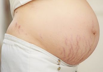 Cegah Stretch Marks Sejak Awal Kehamilan, Ini Caranya!