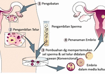Mengenal Program Bayi Tabung, Langkah Demi Langkah