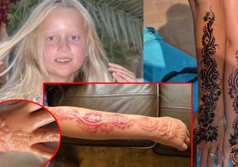 Duh, Kulit Bocah 7 Tahun Ini Jadi Begini Setelah Membuat Tato Henna
