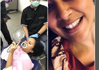 Mau Bleaching Gigi Seperti Sarah Sechan? Coba Dulu 5 Cara Memutihkan Gigi Secara Alami Ini