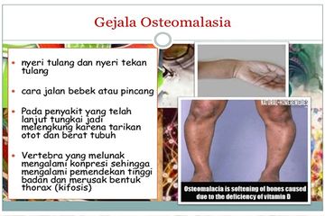 Jarang Yang Tahu Padahal Osteomalasia Sebabkan Gagal Tumbuh Pada Anak Semua Halaman Nakita