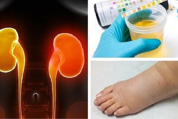 Gagal Ginjal Kronis Bisa Memaksa Kita Transplantasi Ginjal, Hindari Mulai dari Penyebabnya