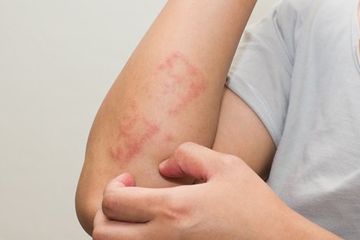 Studi: Penderita Psoriasis Juga Berisiko Alami Penyakit Sendi
