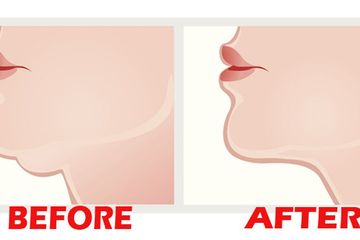 Jangan Galau Lagi Ada Cara Mudah Hilangkan Double Chin Dalam 6