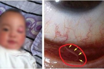 Kok Bisa Mata Anak Usia 2 Tahun Dipenuhi Cacing? Ternyata Ini Penyebabnya