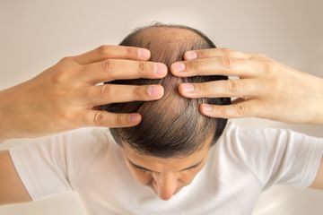 Kerontokan Rambut Saat Menyandang Diabetes, Ini Penyebab dan Perawatannya