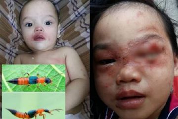 Balita disengat semut charlie.
