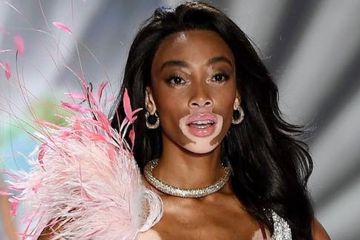 Winnie Harlow, model pengidap Vitiligo