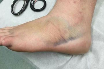 Waspadai kaki menghitam karena Covid-19.