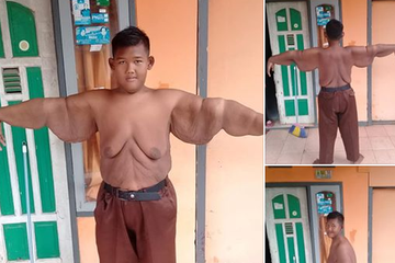 Berat badan Arya Permana turun drastis setelah Operasi penurunan berat badan (Bariatrik).