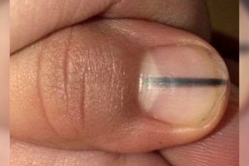 Perhatikan Tubuh Anda 12 Tanda Berikut Ini Bisa Jadi Tunjukan Adanya Penyakit Serius Dalam Tubuh Anda Salah Satunya Garis Gelap Di Kuku Semua Halaman Intisari