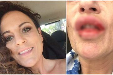 Niatnya ingin menjadi seksi dengan lakukan lip filler, bibir wanita ini justru menjadi parah 