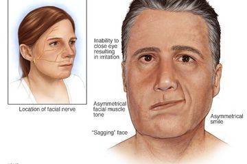 Wajah penderita Bell's palsy (belpasi)
