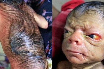 Alami Benjamin Button Disease, Bayi Ini Bikin Geger Ruang Operasi Pasca Kelahirannya