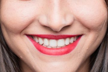 Lebih Berbahaya Dari Gigi Berlubang Tenyata Karang Gigi Yang Kerap Dianggap Sepele Bisa Picu Penyakit Jantung Dan Lainnya Semua Halaman Nakita