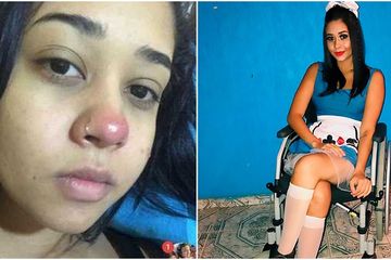 Gadis ini lumpuh setelah tindik hidung