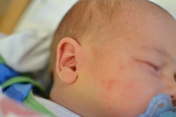 Kenali penyebab biduran pada bayi 
