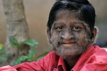 Werewolf Syndrome, Kisah Bocah Langka di India yang Tubuhnya Dipenuhi Rambut